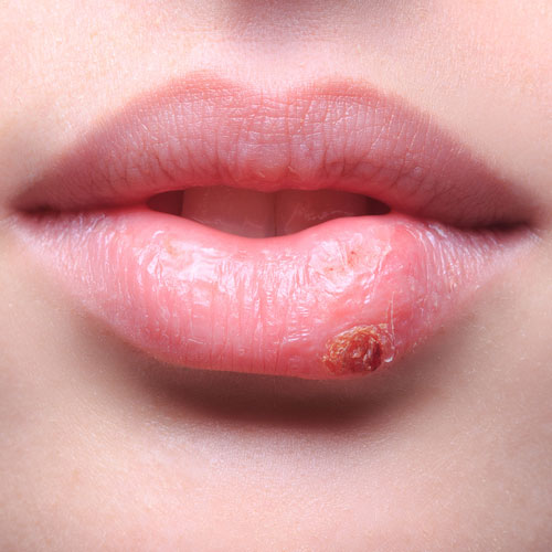 Najefikasniji-prirodni-proizvodi-protiv-herpes-simpleks-virusa