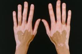 vitiligo